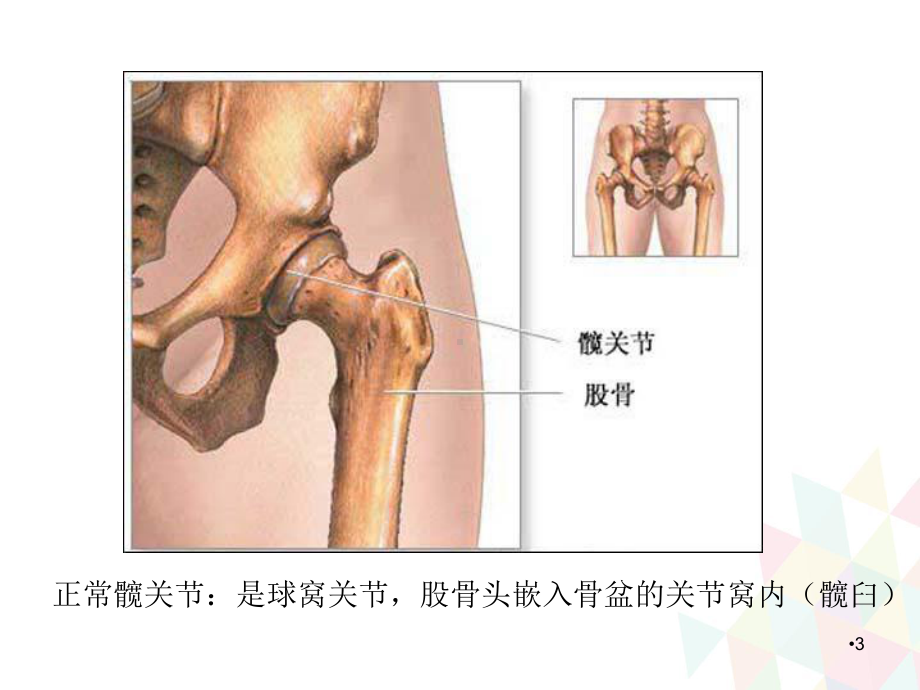 人工髋关节置换术后的护理学习课件.ppt_第3页