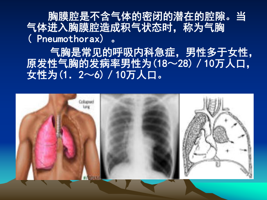 医学自发性气胸专题医学知识宣讲专题培训课件.ppt_第2页