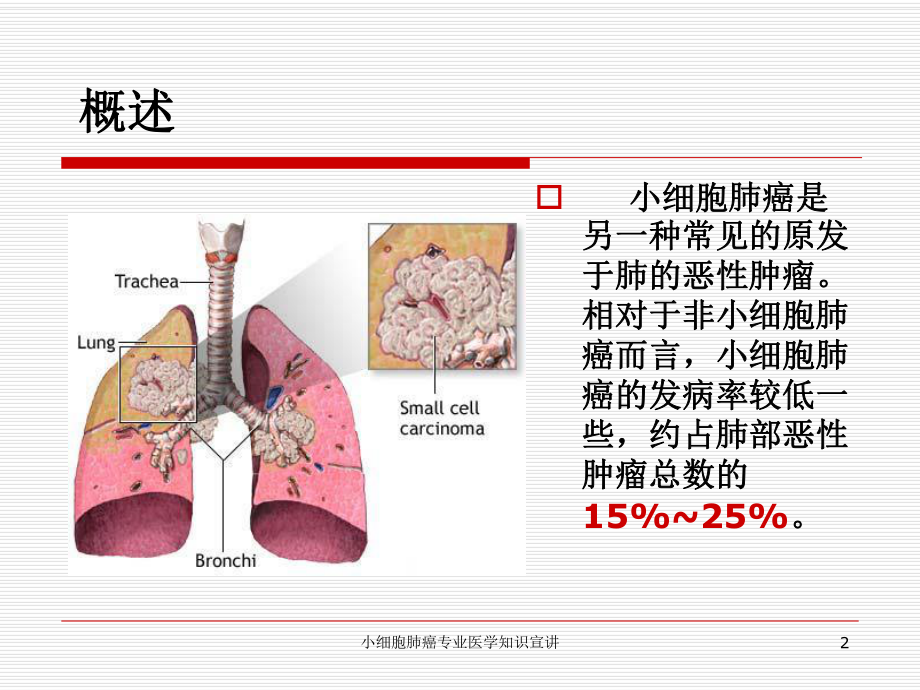 小细胞肺癌专业医学知识宣讲培训课件.ppt_第2页