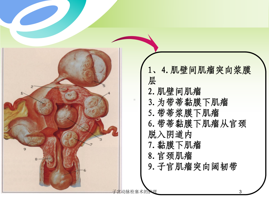 子宫动脉栓塞术的护理培训课件.ppt_第3页