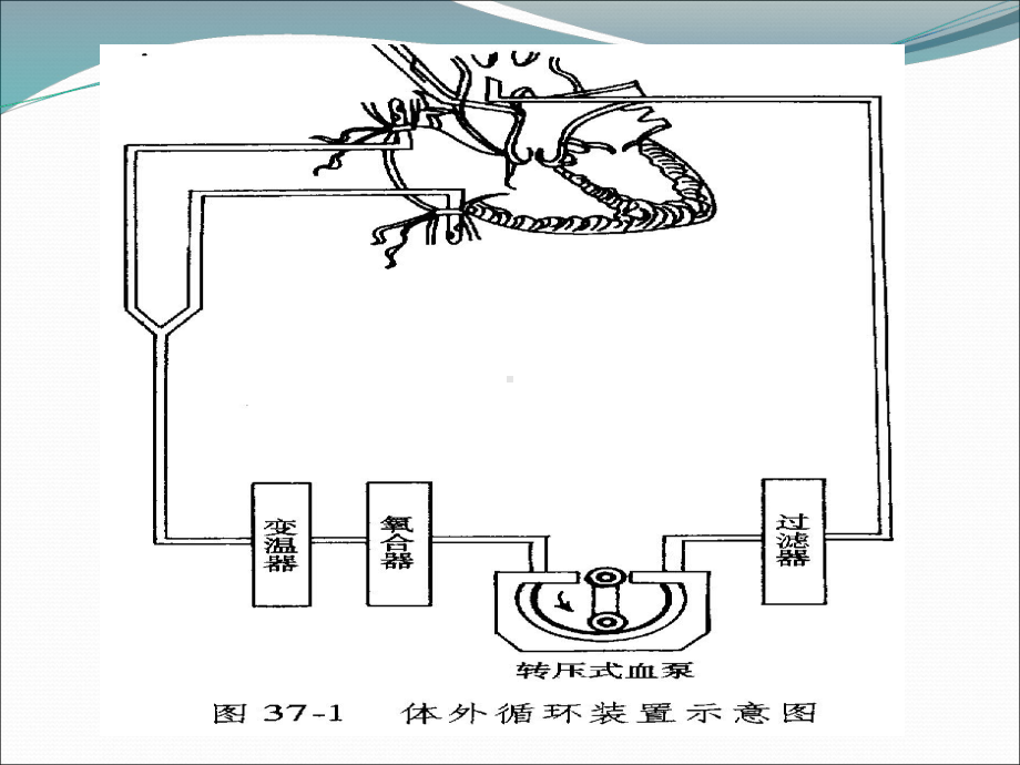 体外循环护理(讲)课件.ppt_第3页