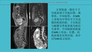 前置胎盘专题讲座课件.ppt