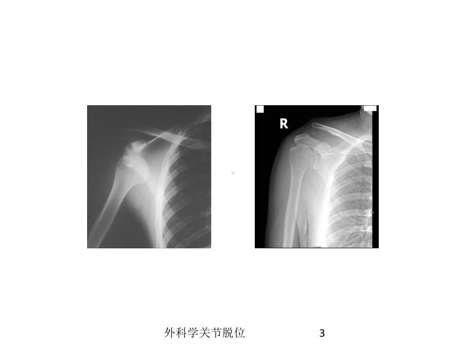 外科学关节脱位培训课件.ppt_第3页