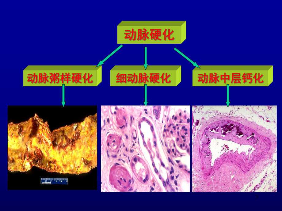 动脉硬化1课件.ppt_第3页