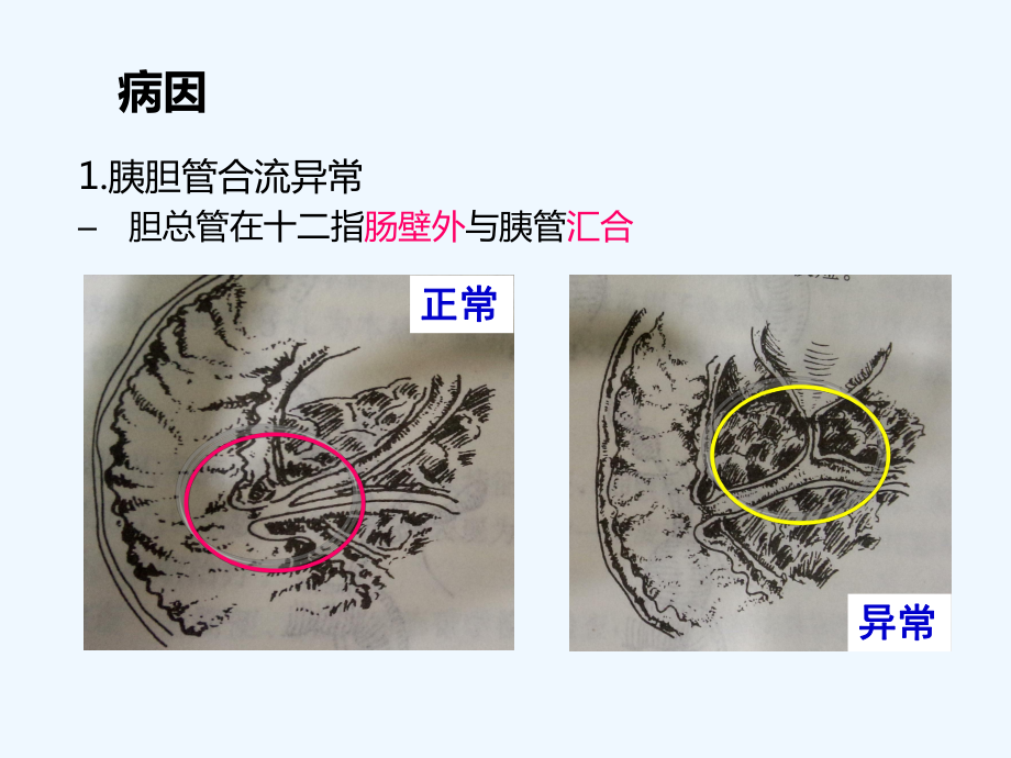 先天性胆总管囊肿的护理课件.ppt_第3页