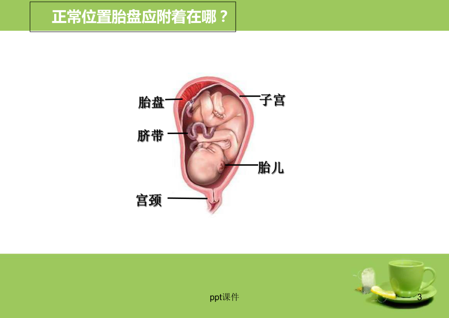 前置胎盘-课件.ppt_第3页