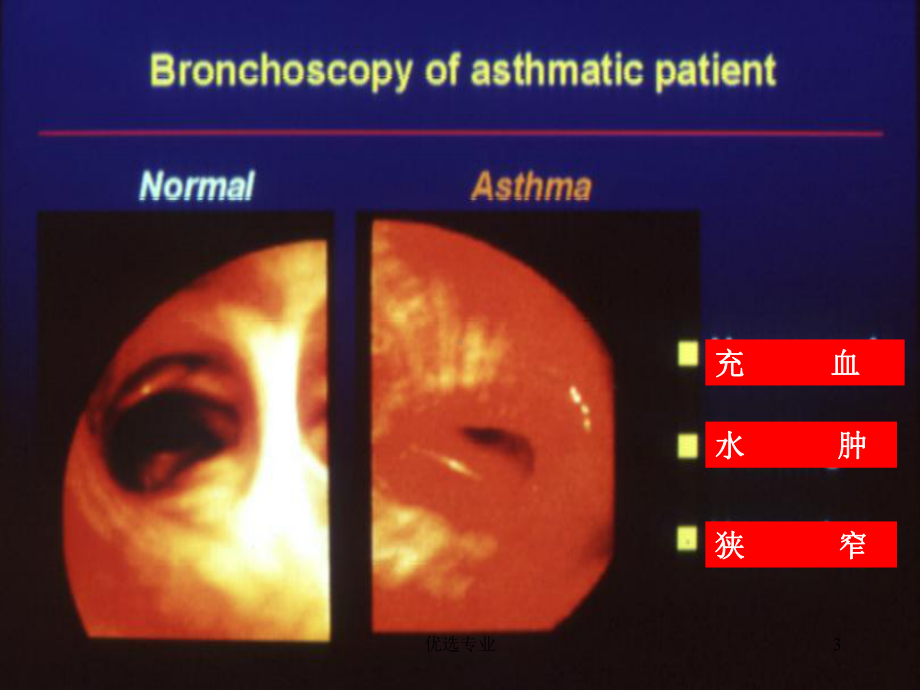 哮喘诊断及鉴别诊断(行业一类)课件.ppt_第3页