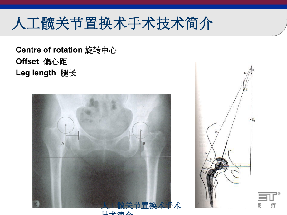 人工髋关节置换术手术技术简介培训课件.ppt_第3页