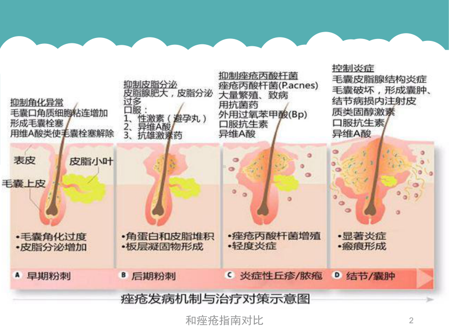 和痤疮指南对比培训课件.ppt_第2页