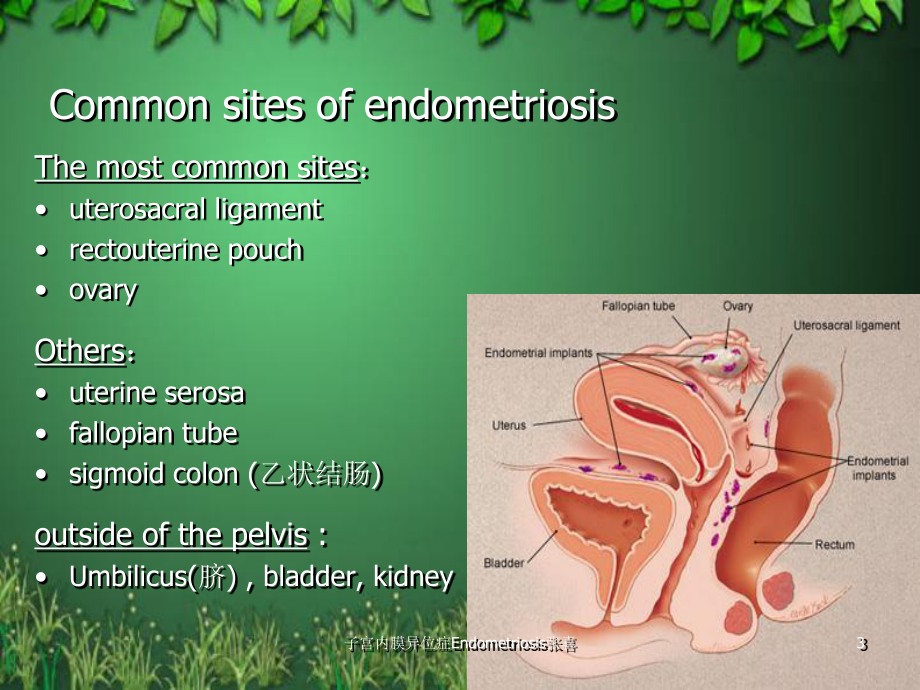 子宫内膜异位症Endometriosis课件.ppt_第3页