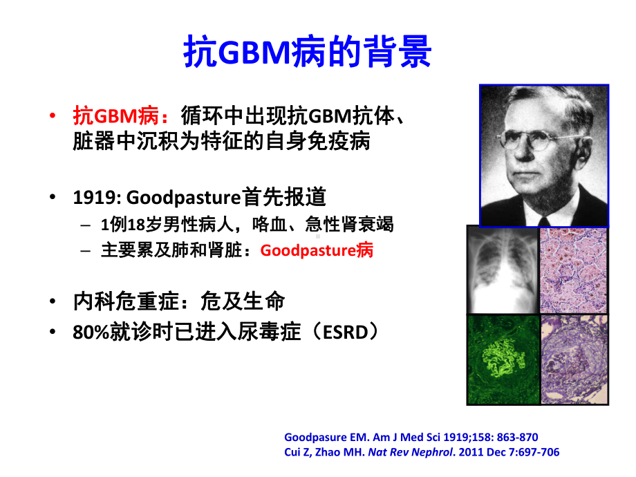 医学课件抗肾小球基底膜GBM病.ppt_第1页