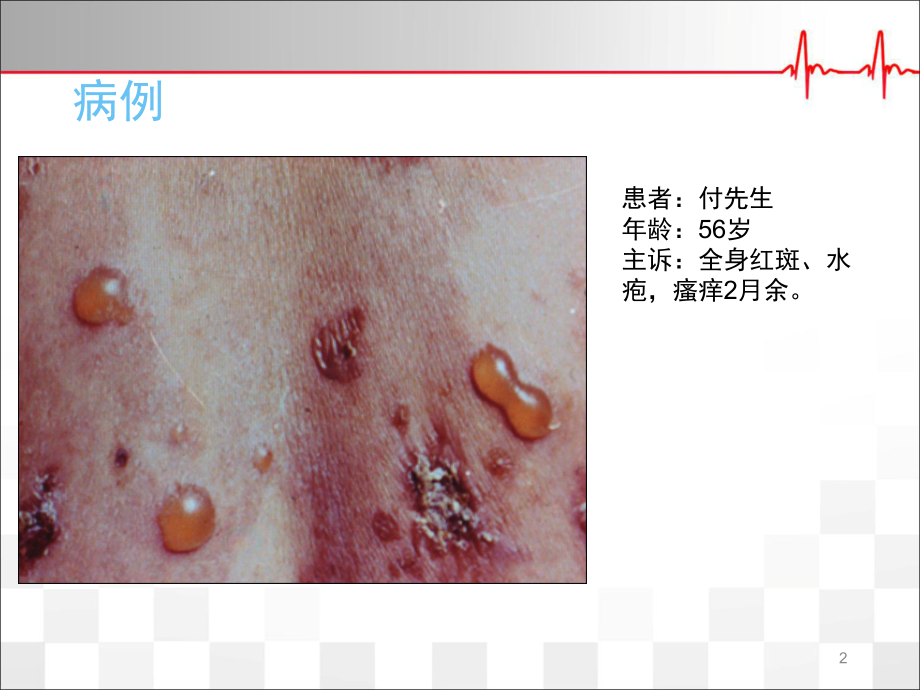 大疱性类天疱疮课件.pptx_第2页