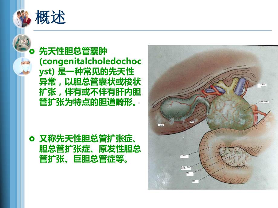 先天性胆总管囊肿及护理课件.pptx_第3页