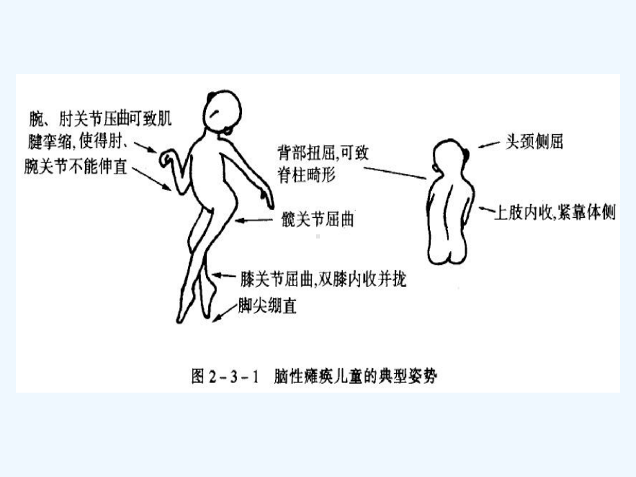 小儿脑瘫的康复中PT师的工作分析课件.ppt_第3页