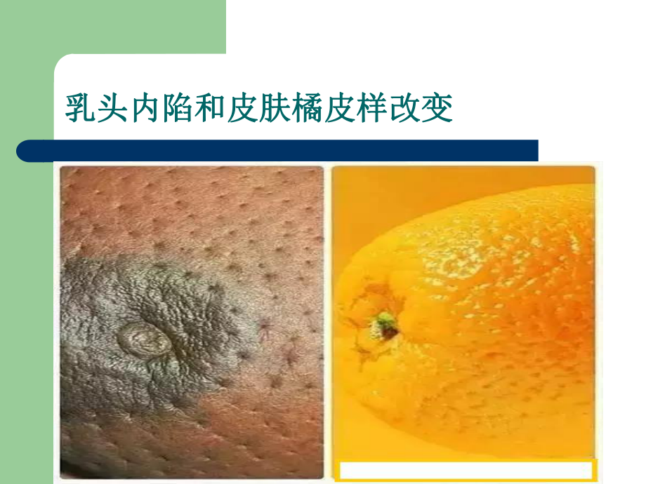 乳腺癌诊疗流程课件.ppt_第3页