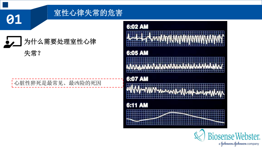 室性心律失常的射频消融治疗培训课件.ppt_第1页