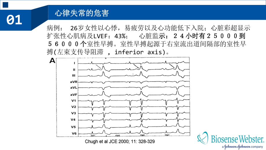 室性心律失常的射频消融治疗培训课件.ppt_第2页