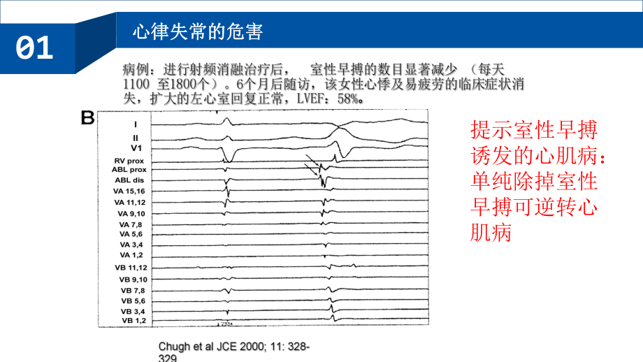 室性心律失常的射频消融治疗培训课件.ppt_第3页