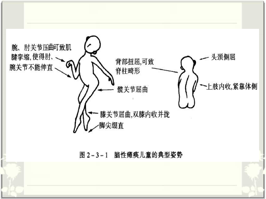 小儿脑瘫的康复课件.ppt_第3页