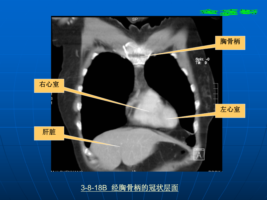 医学胸部冠状面矢状面解剖与影像培训课件.ppt_第3页