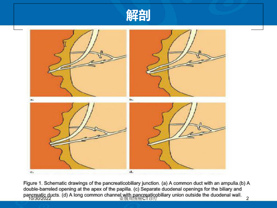 壶腹周围癌CT诊疗课件.ppt_第2页