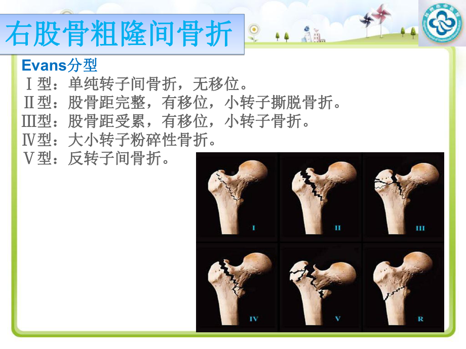 医学左股骨粗隆间骨折护理查房专题培训课件.ppt_第3页