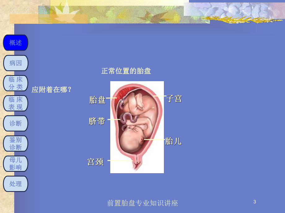 前置胎盘专业知识讲座培训课件.ppt_第3页