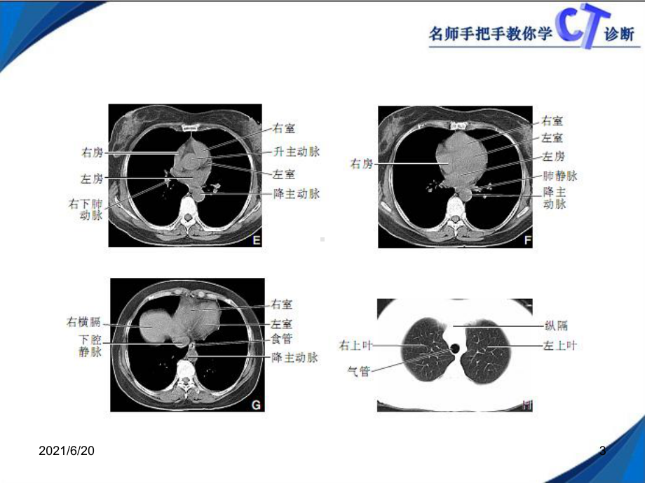 呼吸系统CT课件.ppt_第3页