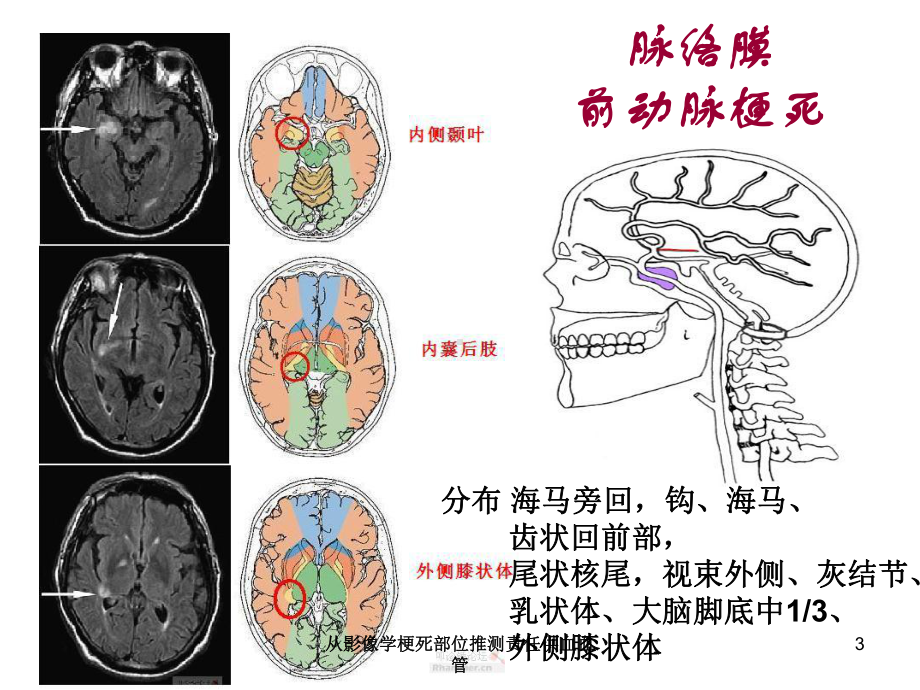 从影像学梗死部位推测责任供血血管培训课件.ppt_第3页