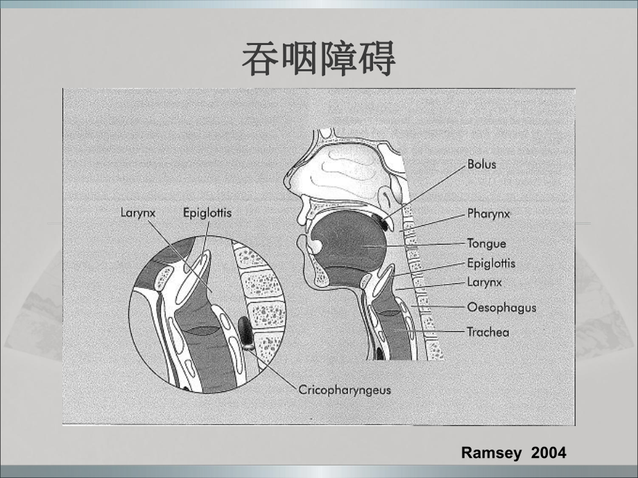 吞咽障碍与治疗课件.pptx_第3页