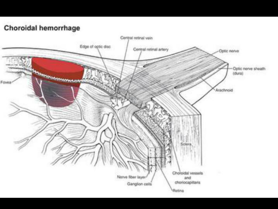 医学课件脉络膜上腔出血.ppt_第1页