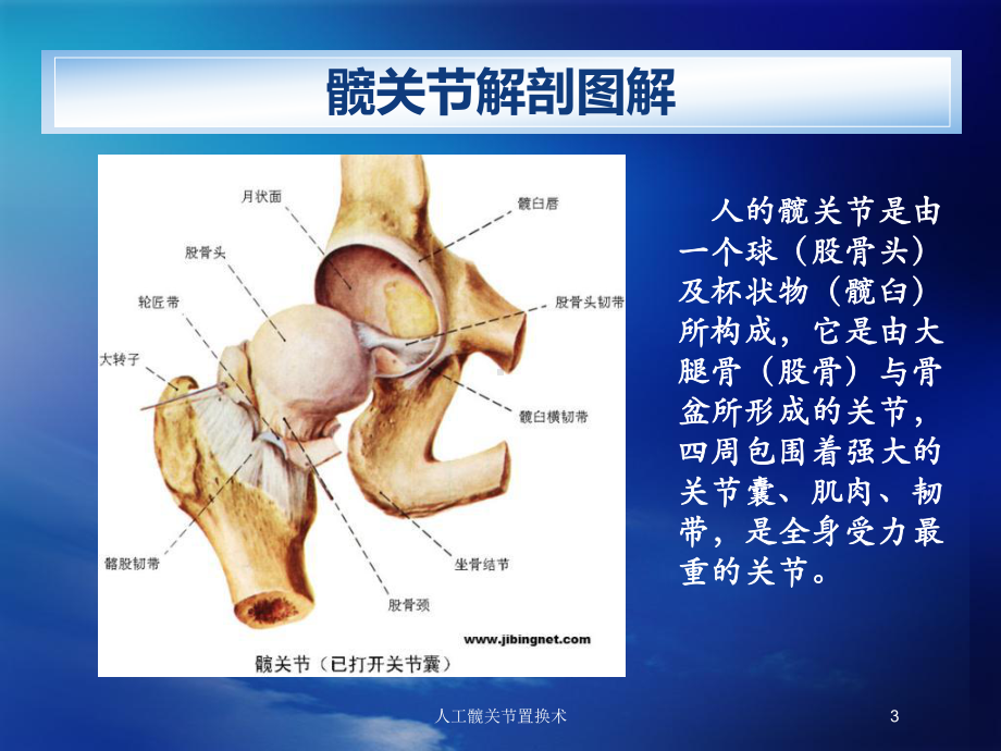 人工髋关节置换术培训课件.ppt_第3页