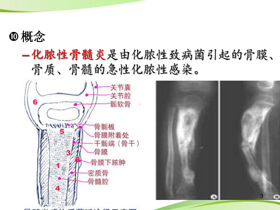 化脓性骨髓炎患者的护理学习课件.ppt_第3页