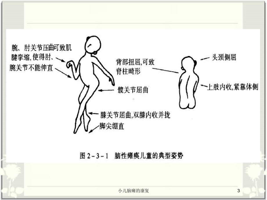 小儿脑瘫的康复培训课件.ppt_第3页