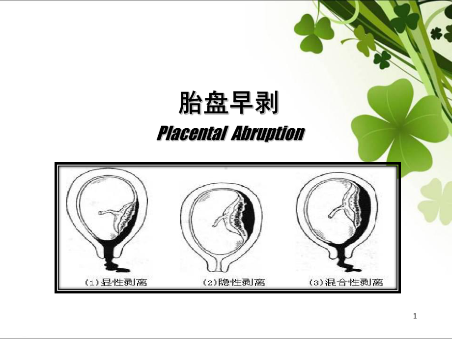 医学课件-胎盘早剥课件.ppt_第1页