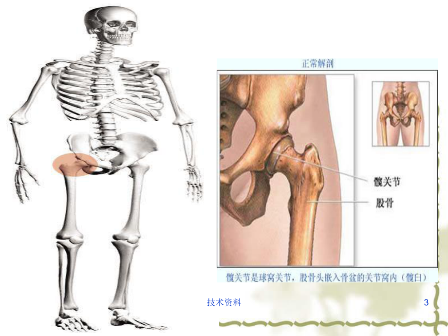 人工髋关节置换术护理(专业研究)课件.ppt_第3页