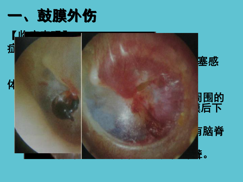 五官科学第六章耳鼻咽喉科常见疾病耳部疾病课件.ppt_第3页