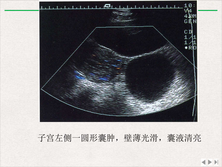 卵巢疾病的超声鉴别诊断新版课件.ppt_第3页