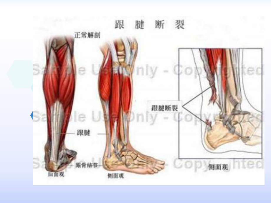 医学课件跟腱断裂医疗护理查房.ppt_第2页