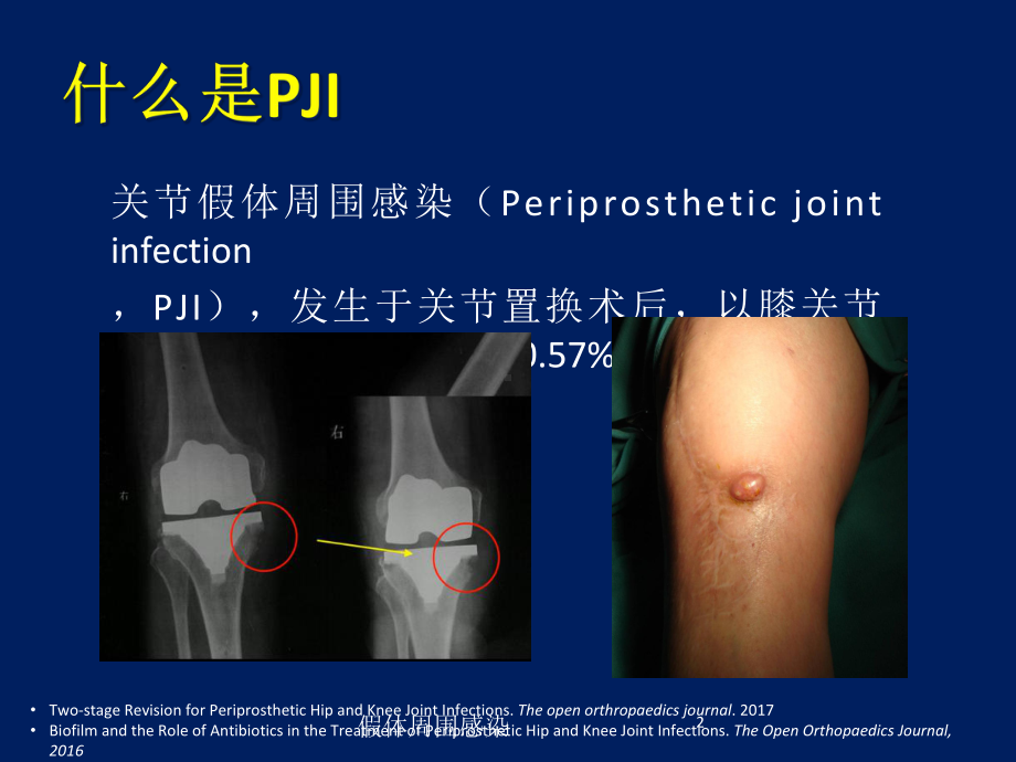 假体周围感染培训课件.ppt_第2页