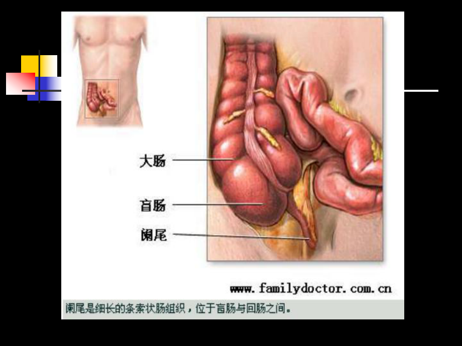 外科护理学阑尾炎病人的护理培训课件.ppt_第3页