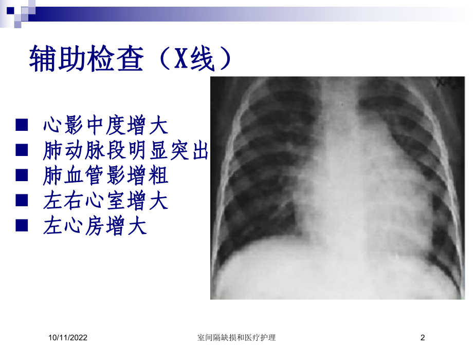 室间隔缺损和医疗护理课件.ppt_第2页