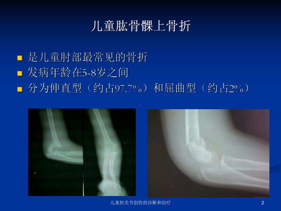 儿童肘关节创伤的诊断和治疗课件.ppt_第2页