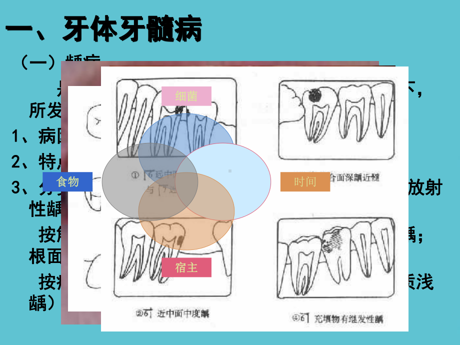 五官科学第九章口腔科常见疾病课件-2.ppt_第3页