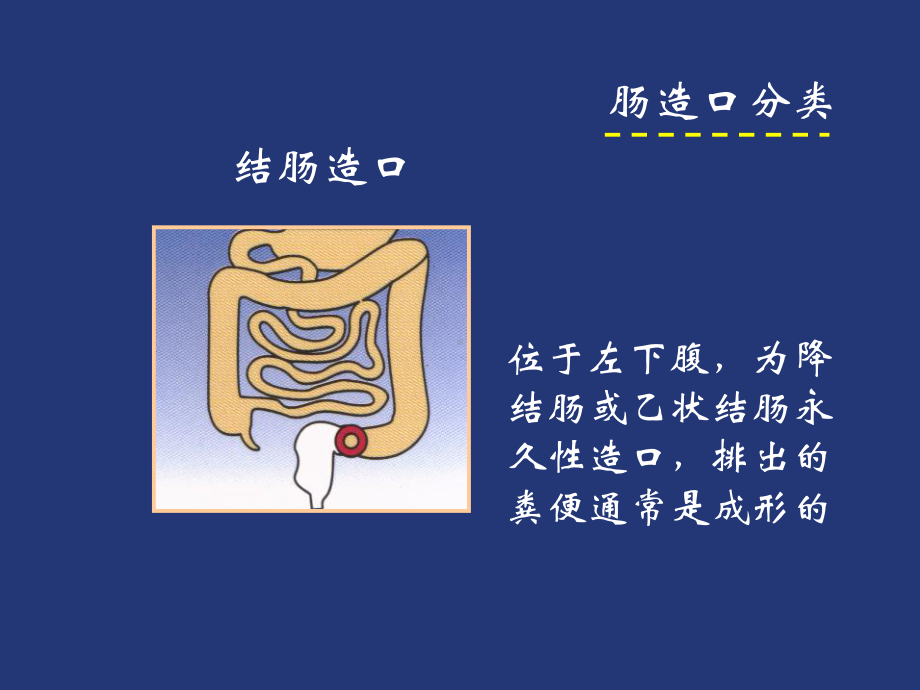 人工肛门的护理课件.ppt_第3页