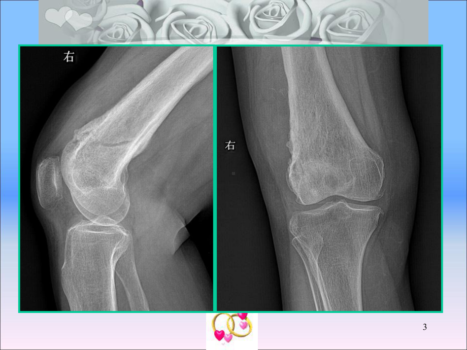 原发骨脂肪肉瘤课件.ppt_第3页