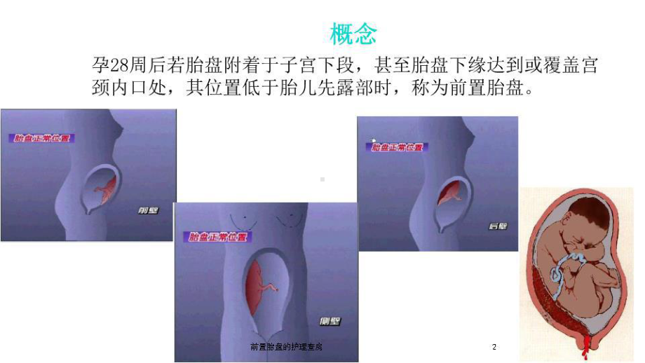 前置胎盘的护理查房培训课件.ppt_第2页