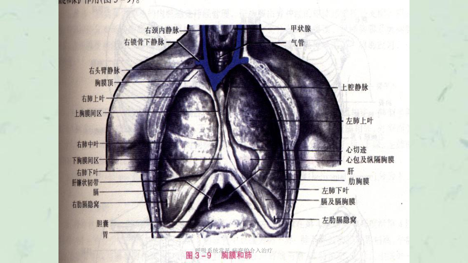 呼吸系统常见-病变的介入治疗课件.ppt_第3页