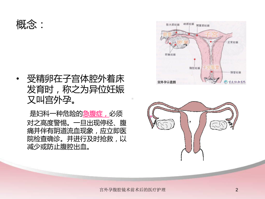 宫外孕腹腔镜术前术后的医疗护理培训课件.ppt_第2页