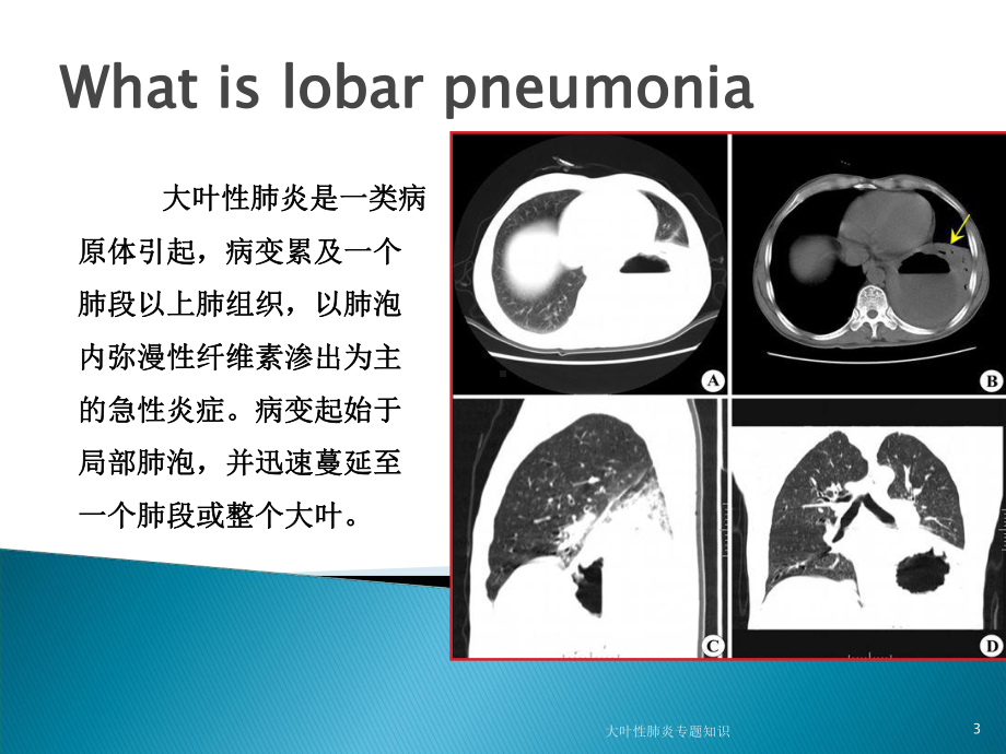 大叶性肺炎专题知识培训课件.ppt_第3页